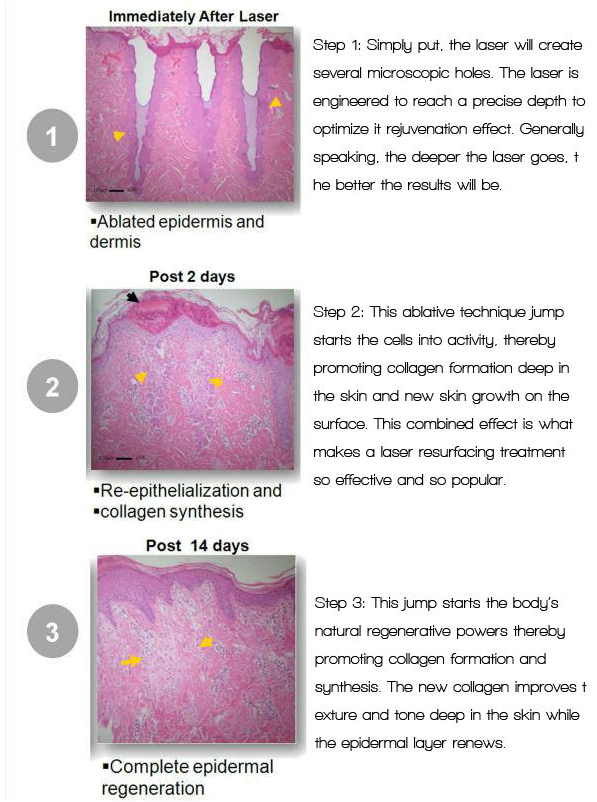 Co2 Fractional Laser Clinic Salon Equipment Co2 Fractional Laser Clinic Salon Equipment