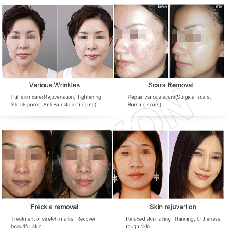 Co2 Fractional Laser Clinic Salon Equipment Co2 Fractional Laser Clinic Salon Equipment