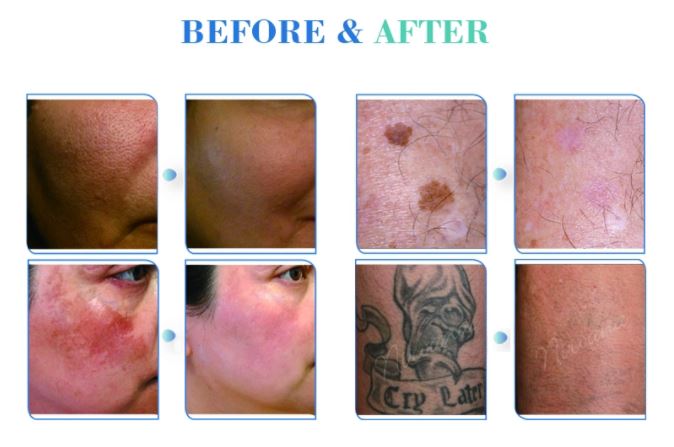 Q Switch ND Yag Laser Picosecond Laser/ Picosecond Laser Tattoo Removal Machine For Sale Q Switch ND Yag Laser Picosecond Laser/ Picosecond Laser Tattoo Removal Machine For Sale